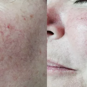 Lumecca Before and After Treatment | Mason Aesthetics & Wellness in West Haven, UT