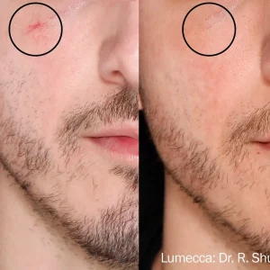 Lumecca Before and After Men Treatment Photos | Mason Aesthetics & Wellness in West Haven, UT