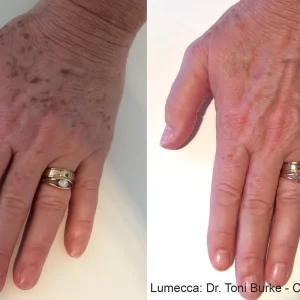 Lumecca Before and After Hand Treatment Photos | Mason Aesthetics & Wellness in West Haven, UT