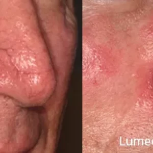 Lumecca Before and After Treatment Photos | Mason Aesthetics & Wellness in West Haven, UT