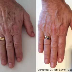 Lumecca Before and After Hands Treatment | Mason Aesthetics & Wellness in West Haven, UT
