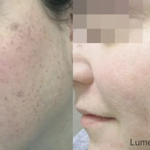 Lumecca Before and After Treatment Photos | Mason Aesthetics & Wellness in West Haven, UT