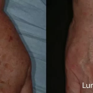 Lumecca Before & After Hand Treatment Photos | Mason Aesthetics & Wellness in West Haven, UT