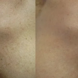 Lumecca Before and After Chest Treatment Photos | Mason Aesthetics & Wellness in West Haven, UT