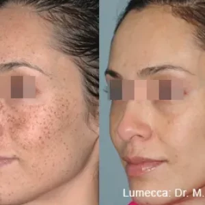 Lumecca Before & After Treatment Photos | Mason Aesthetics & Wellness in West Haven, UT