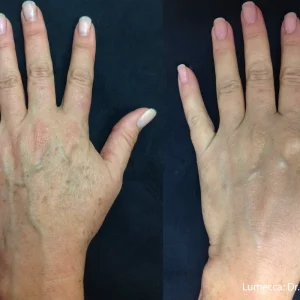 Lumecca Before & After Treatment Hand Photos | Mason Aesthetics & Wellness in West Haven, UT