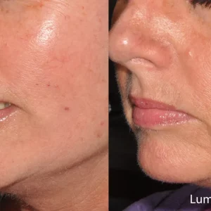 Lumecca Before & After Photos | Mason Aesthetics & Wellness in West Haven, UT